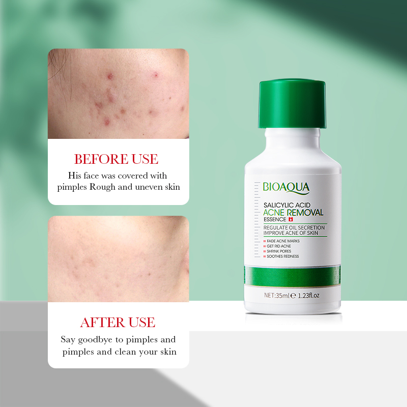 35 مللي BIOAOUA حمض الساليسيلي - مراجعة Salicylic Acid Blackhead Remover وسعره