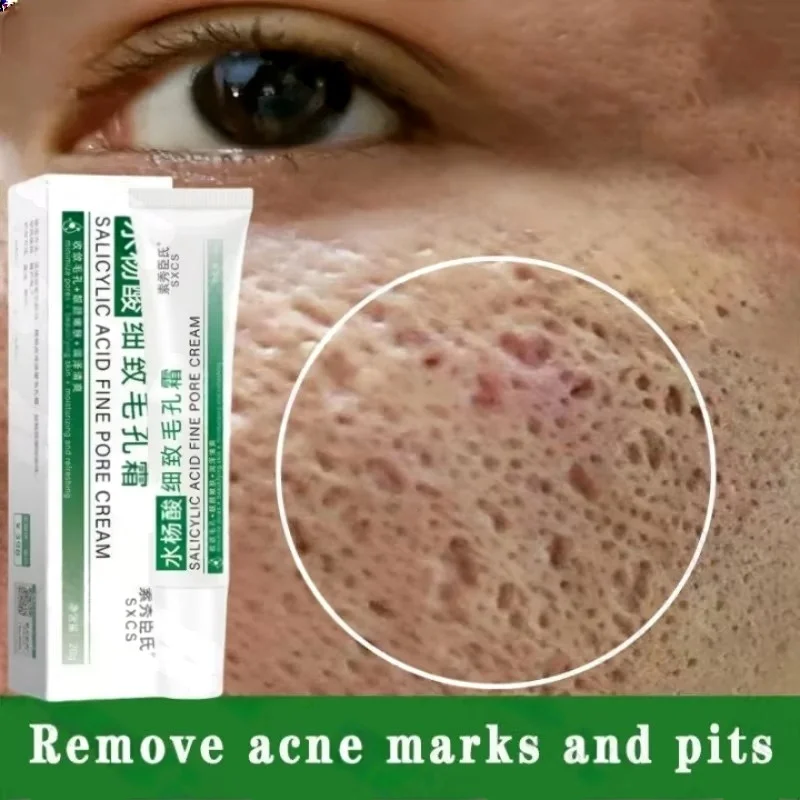 حمض الساليسيليك كريم إزالة الم - مراجعة Salicylic Acid Blackhead Remover وسعره