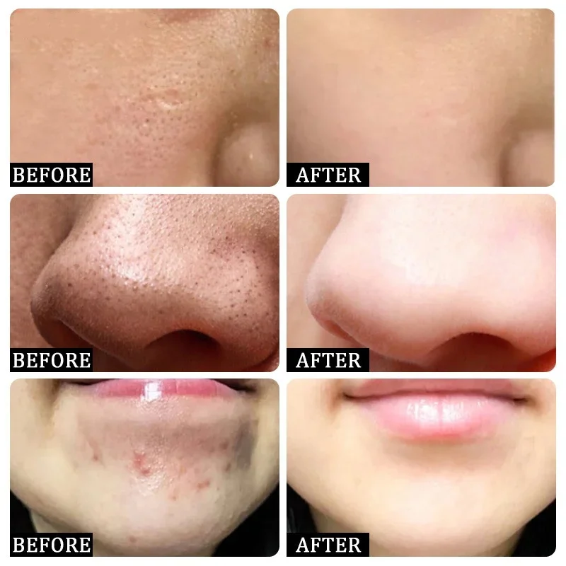 حمض الساليسيليك كريم إزالة الم - مراجعة Salicylic Acid Blackhead Remover وسعره