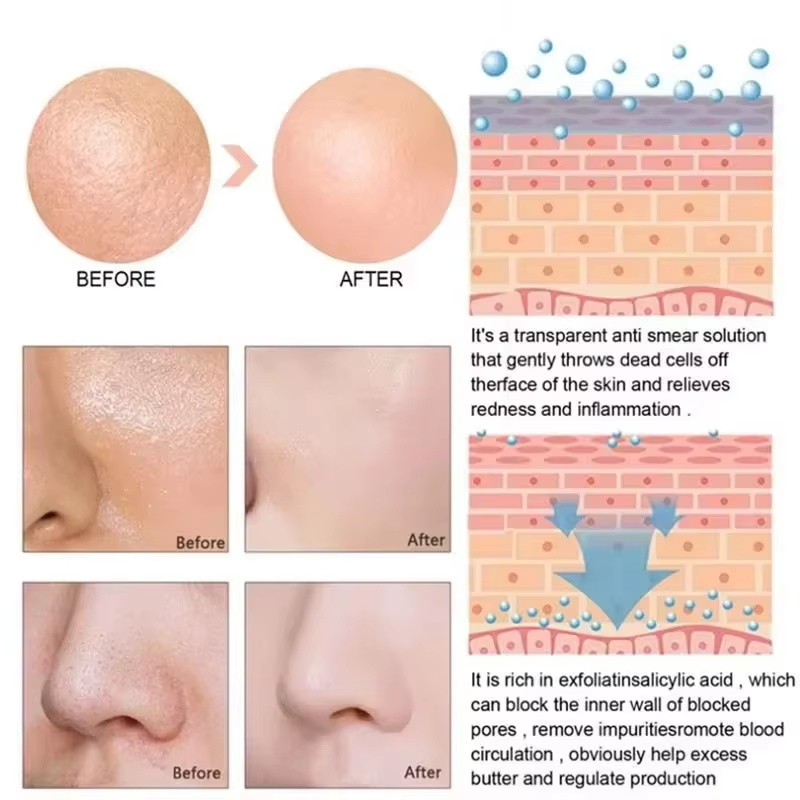 سيروم حمض الساليسيليك لتضييق ا - مراجعة Salicylic Acid Blackhead Remover وسعره
