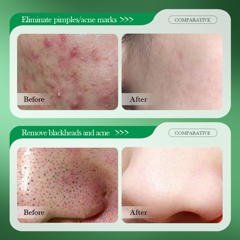 كريم علاج حب الشباب بحمض السال - مراجعة Salicylic Acid Blackhead Remover وسعره